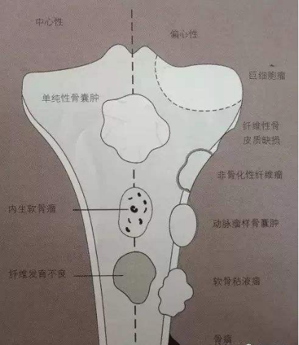 骨腫瘤是什么病，癥狀有哪些？