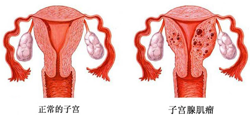 子宮腺肌病的聚焦超聲消融手術(shù)治療