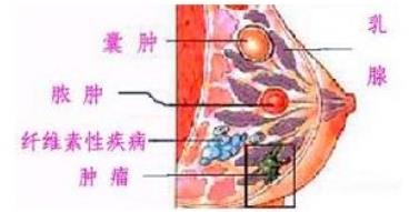 乳腺癌的癥狀有哪些？如何治療？