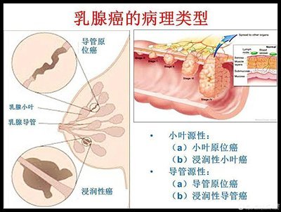 胰腺癌容易發(fā)生在老年人身上，其中大多數(shù)發(fā)生在60歲以上的人群中