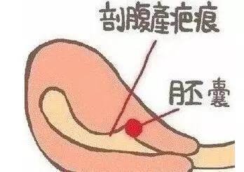 有關子宮肌瘤的病因迄今仍不十分清楚